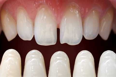 How often do you have to get veneers checked?