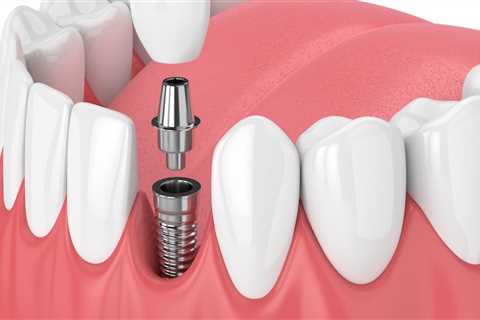 Cost And Timeframe Of Receiving Dental Implants In Mansfield, Texas