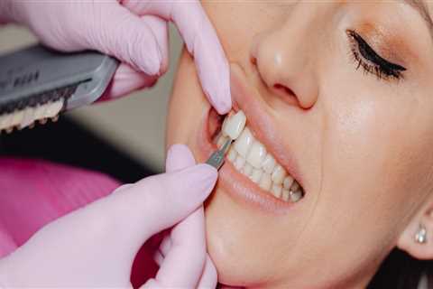 Exploring The Different Types Of Dental Veneer Procedures Available In Mansfield