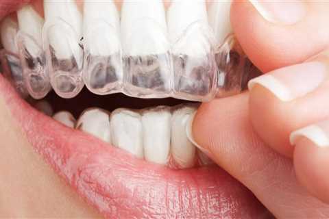 Can Invisalign Cause Root Damage? - An Expert's Perspective