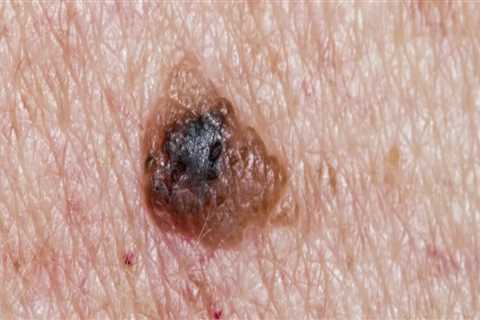 Understanding the Risk Factors of Melanoma Skin Cancer