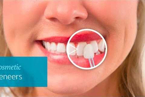 Dental Veneers W1 Holborn Camden London - Forest & Ray - Dentists, Orthodontists, Implant Surgeons