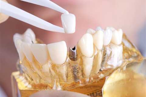 Standard post published to Smalto Dental Clinic at April 06, 2023 10:00