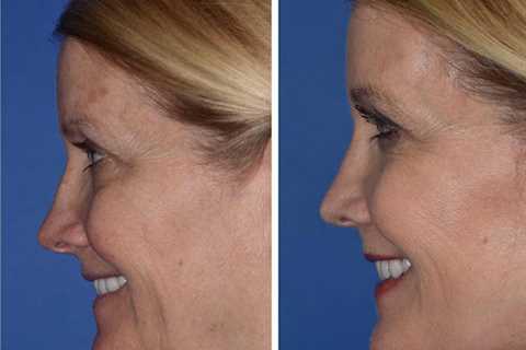 The Seattle Rhinoplasty Center