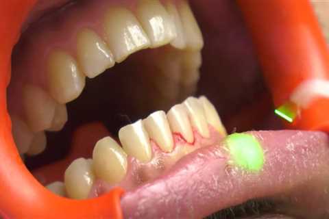 The Benefits of Laser Teeth Cleaning