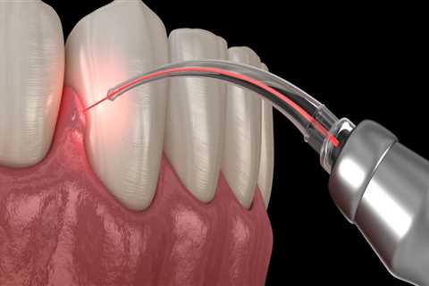 Is Laser Deep Cleaning Teeth Safe? A Comprehensive Guide