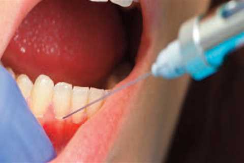 How Long Does a TENS Treatment Last in Dentistry?