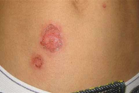 Impetigo: A Comprehensive Overview