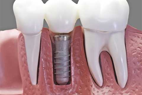 Understanding the Game-Changing Benefits of Dental Implants for Missing Teeth