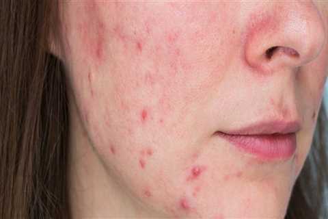 Antibiotics for Adult Acne: A Comprehensive Overview