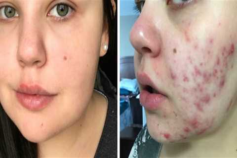 Serums and Oils for Acne Scars: A Complete Overview