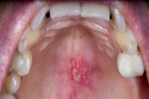 Painful Sores or Blisters in the Mouth - An Overview