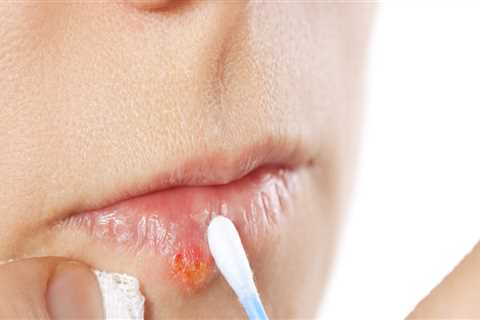 Using Ice Cubes for Cold Compresses: A Home Remedy for Mouth Herpes