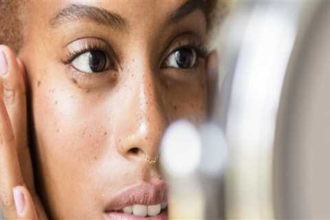 Prescription Medications for Adult Acne: A Comprehensive Overview