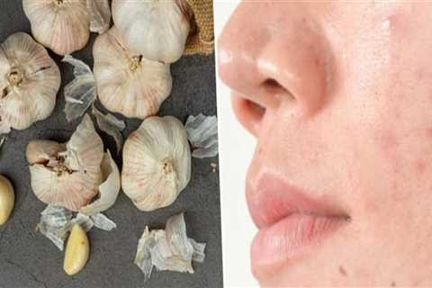 Natural Remedies for Acne: Garlic and Its Benefits