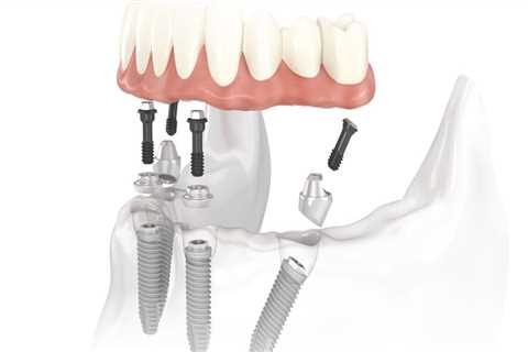 What Type of Dentist Performs All-on-Four Denture Procedures?