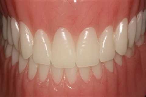 Can Dentures Be Adjusted to Fit Tighter?