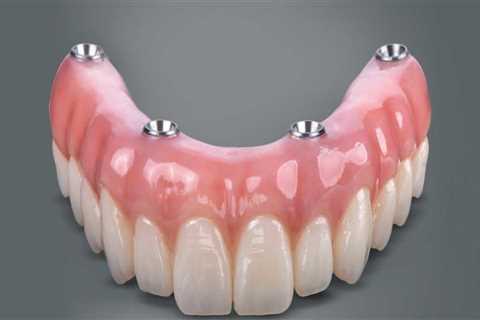 Getting All-on-Four Dentures: A Step-by-Step Guide