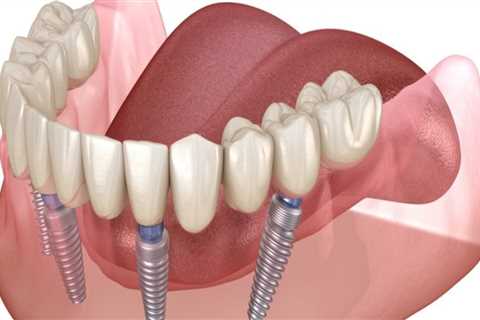 Recovering from All-on-Four Dental Implants: How Long Does It Take?