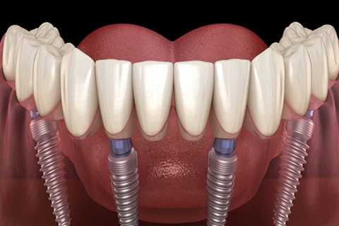 Can All-on-Four Dentures Replace Missing Teeth?