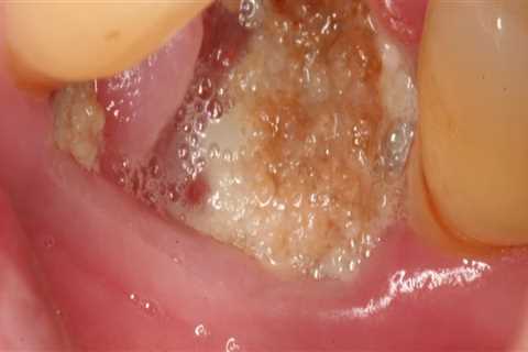 Signs of Infection After Tooth Extraction: What to Look Out For