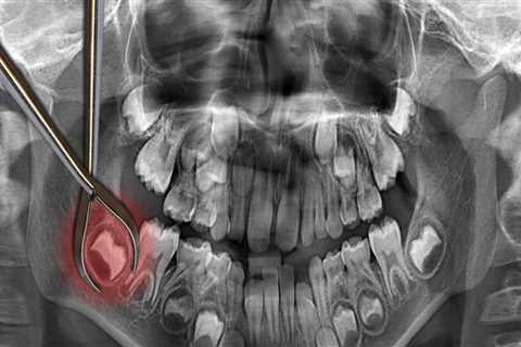 How Long Does It Take to Get All 4 Wisdom Teeth Removed?