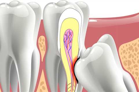 The Benefits of Wisdom Tooth Extraction: Why You Should Consider Removing Your Wisdom Teeth