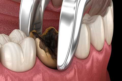 What is the Process for Wisdom Teeth Removal?