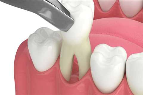 How to Reduce Pain and Swelling After a Tooth Extraction