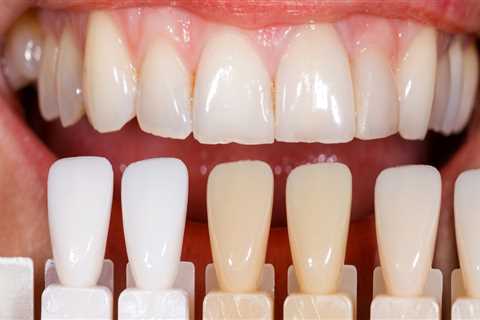 Can veneers be done twice?