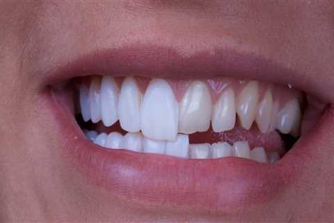 What dental veneers?