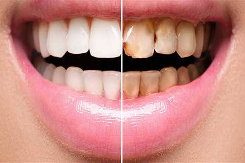 Which veneers last longest?