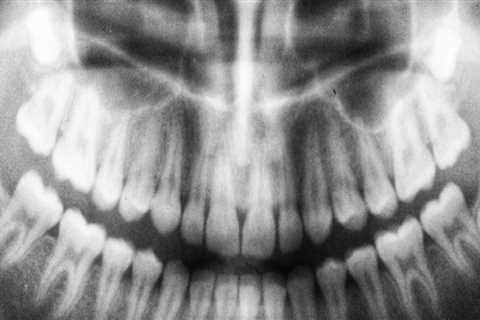 What Is The Importance Of Dental X-Rays In Dentistry In Austin, TX