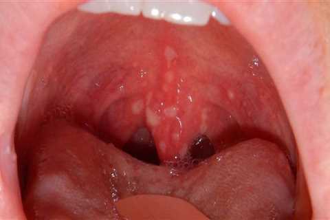 What are some examples of mouth diseases?