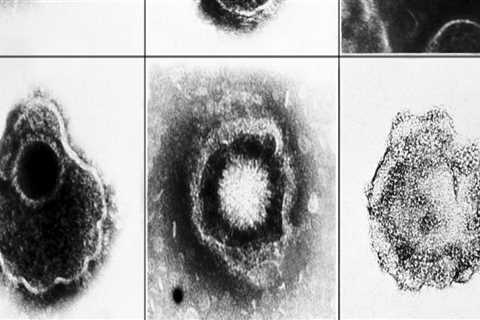 Understanding Antibody Tests for Oral Herpes Diagnosis