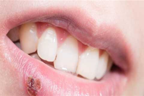 The Risks of Recurrent Outbreaks and Long-Term Complications of Oral Herpes