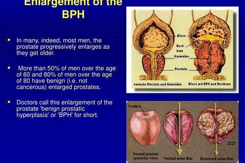 Natural Remedy For Benign Prostatic Hyperplasia and Enlarged Prostate — oxpolish97