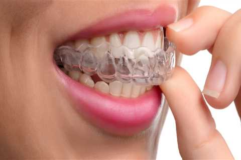 Can Clear Aligners Straighten Teeth?