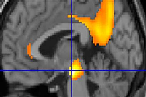 Clinical Diagnosis of Alzheimer's Disease: A Comprehensive Overview