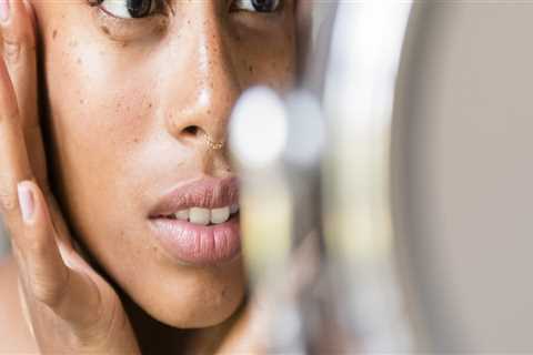 Topical Retinoids for Adult Acne: A Guide to Medical Treatments