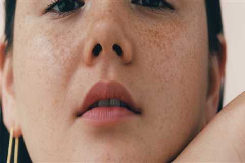 Cosmetics and Acne: A Comprehensive Overview