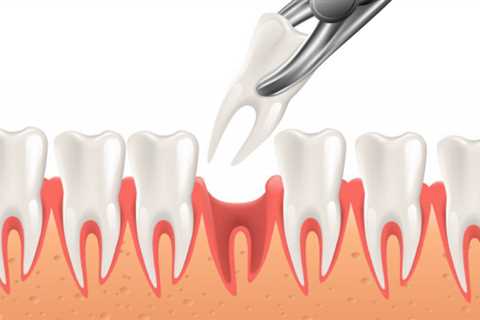 The Greatest Guide To Tooth Extractions