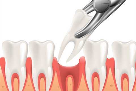 The Basic Principles Of Tooth Extractions