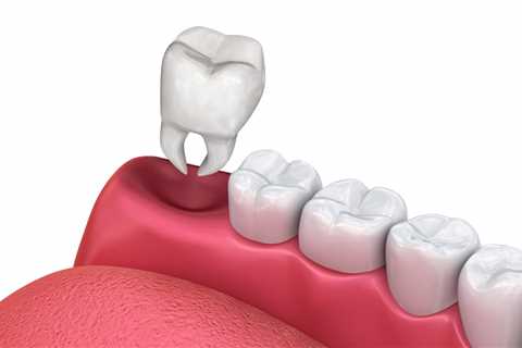 The Main Principles Of Tooth Extractions