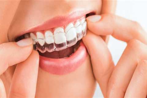 How to Achieve the Shortest Treatment Time with Invisalign