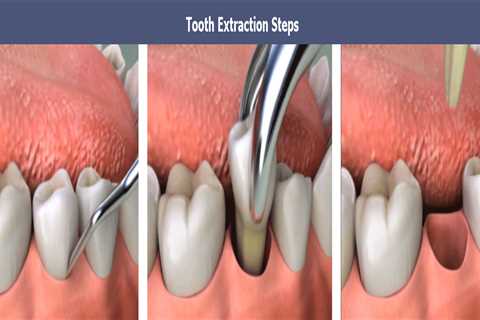 What Does Tooth Extractions Do?