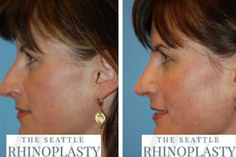 The Seattle Rhinoplasty Center