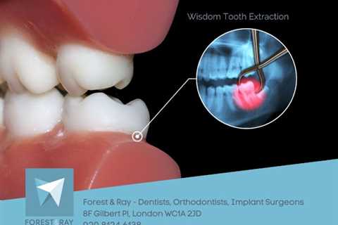 Camden Dental Practice Forest and Ray Shares Vital Information About Wisdom Tooth Extraction