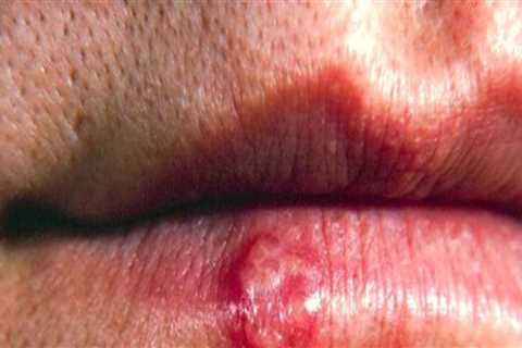 Understanding the Role of a Weakened Immune System in Labialis Herpes