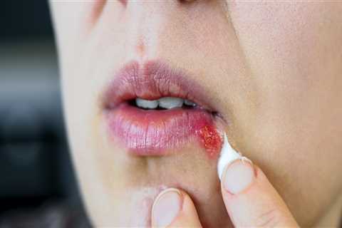 Docosanol Cream: Treatment for Herpes